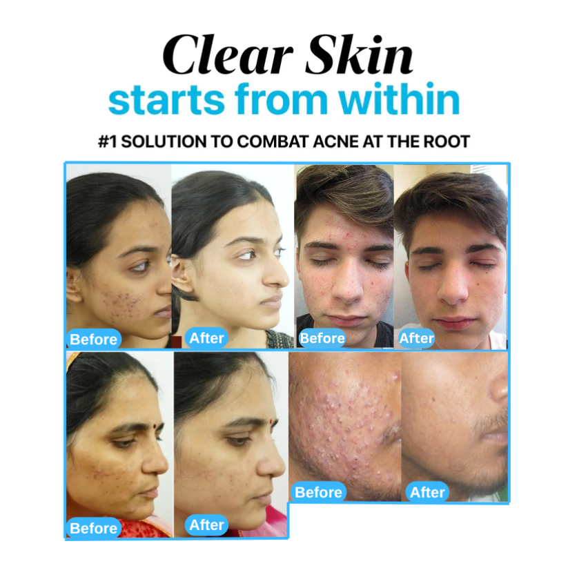 CLEARSKIN™